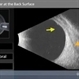Operculated Tear at the Back Surface Operculated Tear at the Back Surface