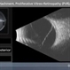 Total Retinal Detachment, Proliferative Vitreo-Retinopathy (PVR), Open Cone Total Retinal Detachment, Proliferative Vitreo-Retinopathy (PVR), Open Cone