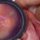 Screening Retinopathy of Prematurity with an Iphone 5 Screening Retinopathy of Prematurity with an Iphone 5