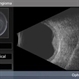 Choroidal Hemangioma Choroidal Hemangioma
