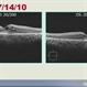 Case Presentation: Retinitis Pigmentosa Case Presentation: Retinitis Pigmentosa