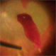Hemorrhage Following Needle Perforation