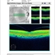 Vitreal Macular Traction