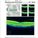 Vitreal Macular Traction