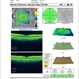 Vitreal Macular Traction
