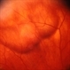 Vortex Vein Varix - supine Vortex Vein Varix - supine