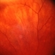Vortex Vein Varix - upright and invisible Vortex Vein Varix - upright and invisible