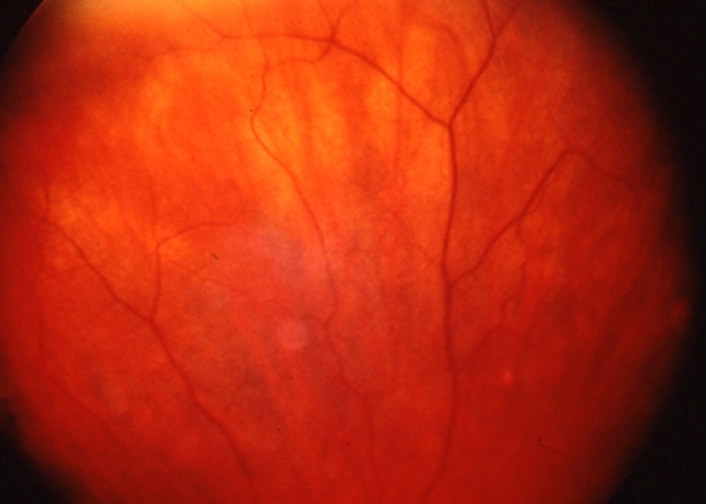 Vortex Vein Varix - upright and invisible - Retina Image Bank