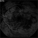 Hypertensive Choroidopathy Hypertensive Choroidopathy