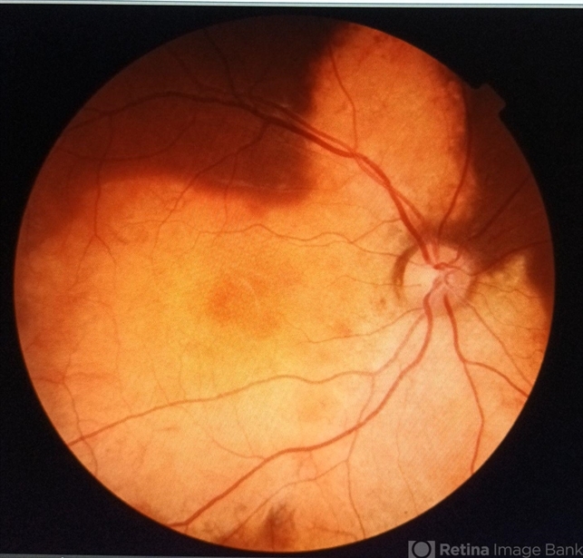 Choroidal osteoma - Retina Image Bank