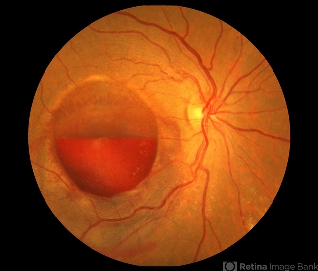 Donut-Shaped Subhyaloidal Hemorrhage - Retina Today