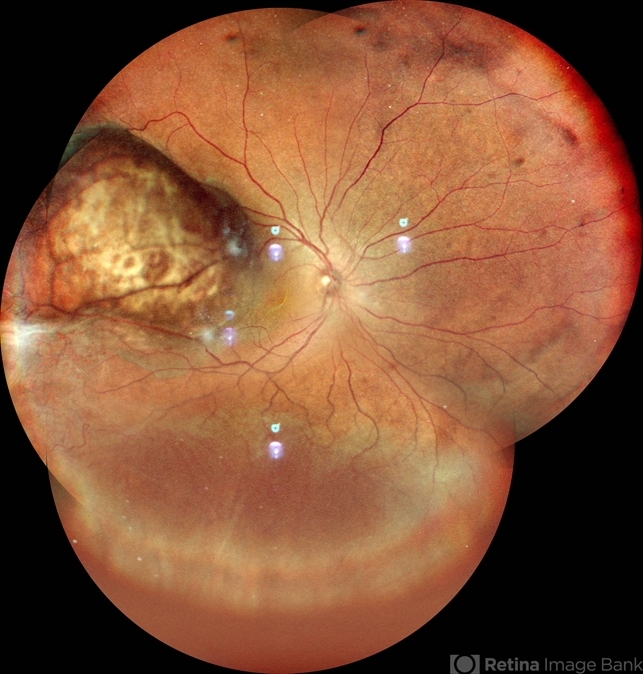 Choroidal Hemangioma - Retina Image Bank