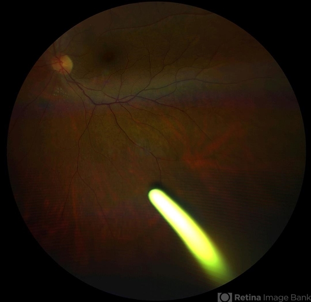 Intravitreal Ozurdex Implant Retina Image Bank intravitreal-ozurdex-implant-retina-image-bank