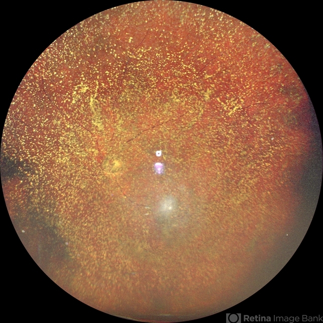 Asteroid Hyalosis Retina Image Bank