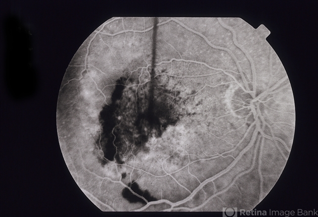 subfoveal choroidal neovascularization icd 10
