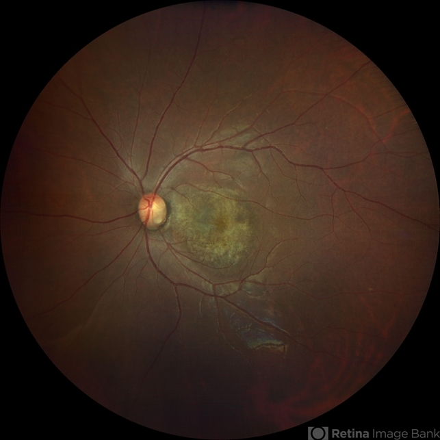 Optic Disc Pit Retina Image Bank