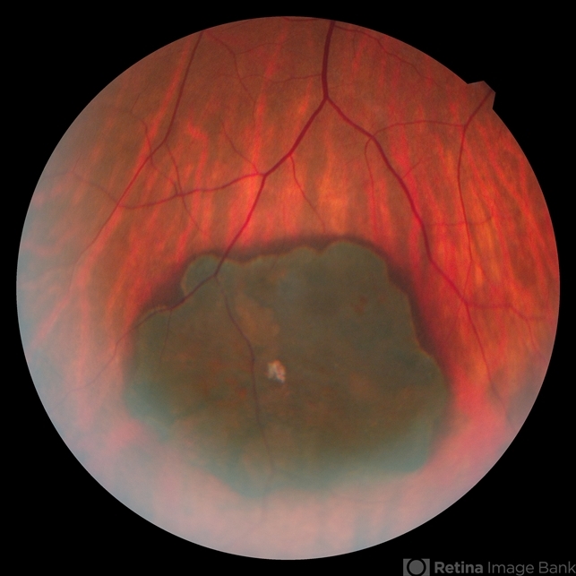 Melanosis - Retina Image Bank