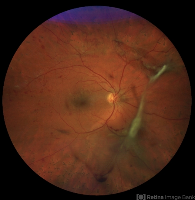 Diabetic Neovascularization - Retina Image Bank