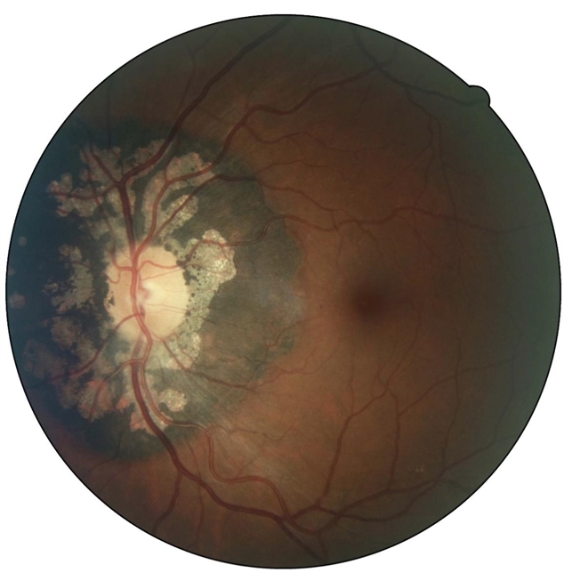 Peripapillary Congenital Hypertrophy of the Retinal Pigment Epithelium ...