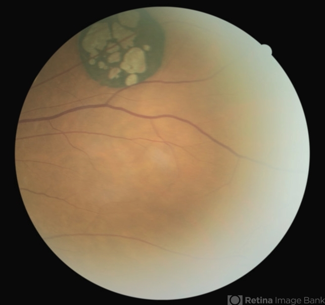 Solitary Congenital Hypertrophy of the Retinal Pigment Epithelium with ...