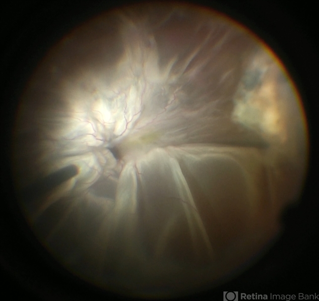 Funnel Retinal Detachment Retina Image Bank