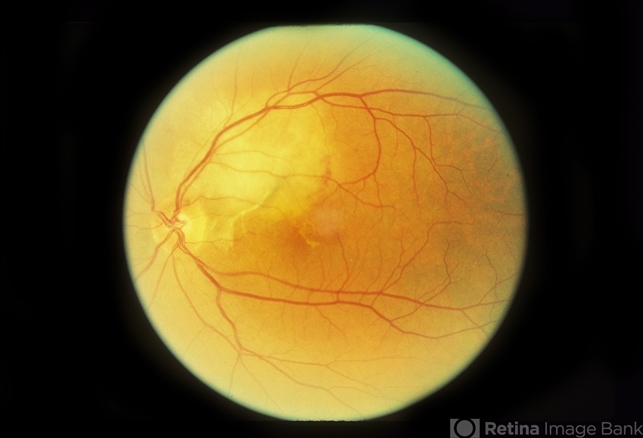 Paracentral Blind Spot And Scotoma - Retina Image Bank