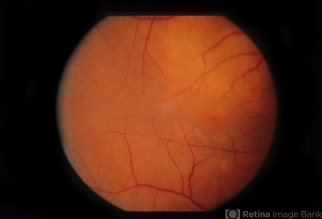 Decreased Visual Acuity - Retina Image Bank