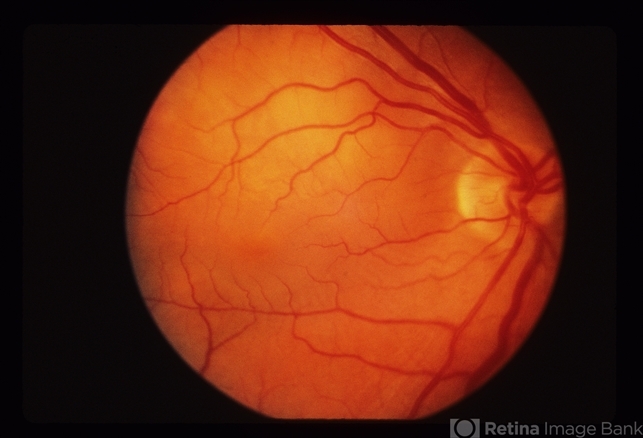 Decreased Visual Acuity - Retina Image Bank
