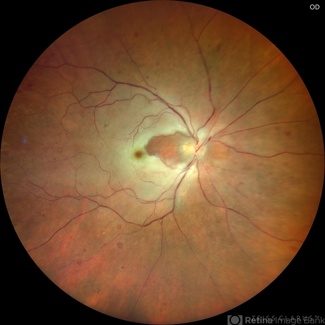 BRAO (Branch Retinal Artery Occlusion) - Retina Image Bank