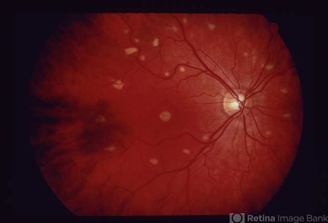 Decreased Visual Acuity Example Decreased Visual Acuity (Case 2) - Retina Image Bank