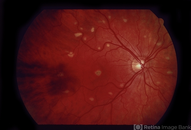 Decreased Visual Acuity (Case 2) - Retina Image Bank