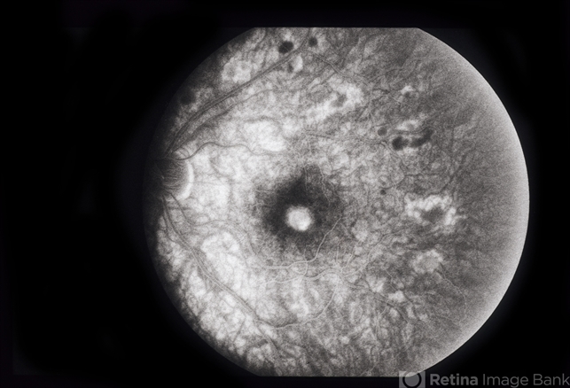 Decreased Visual Acuity (Case 2) - Retina Image Bank