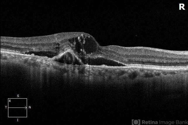 Neovascular Amd With Ring Shaped Lesions Retina Image Bank