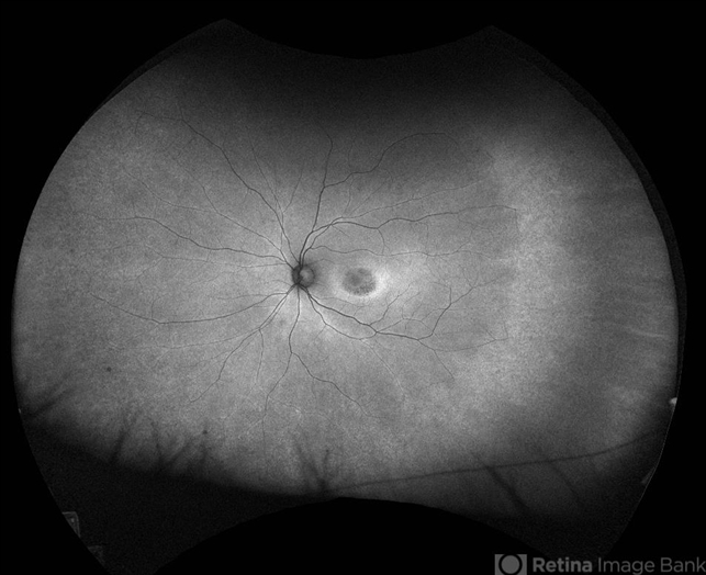 Hydroxychloroquine Maculopathy - Retina Image Bank