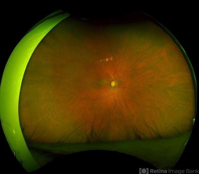 Hydroxychloroquine Maculopathy - Retina Image Bank