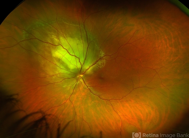 Choroidal Lesion - Retina Image Bank