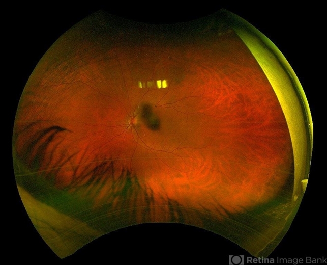 Post Polar Cataract - Retina Image Bank