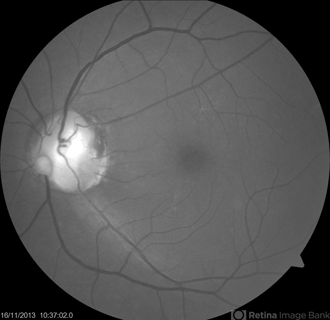 Optic Nerve Coloboma With 2 Pits, Nasal And Temporal Red Free - Retina 