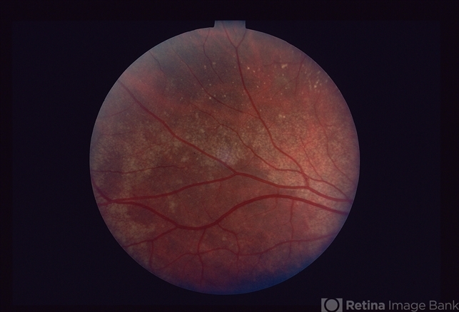 Retinal Pigment Epithelial Changes - Retina Image Bank