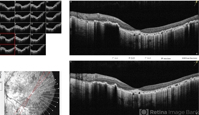 OCT IMAGE - Healed chorioretinitis - Retina Image Bank