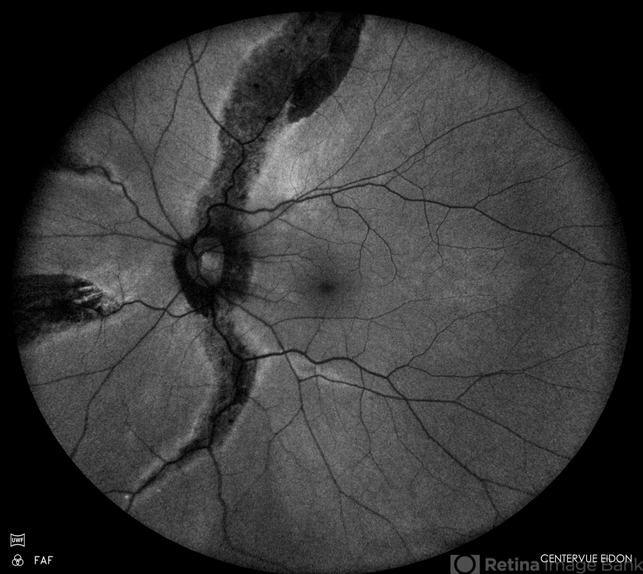 Pigmented Paravenous Retinochoroidal Atrophy - Retina Image Bank