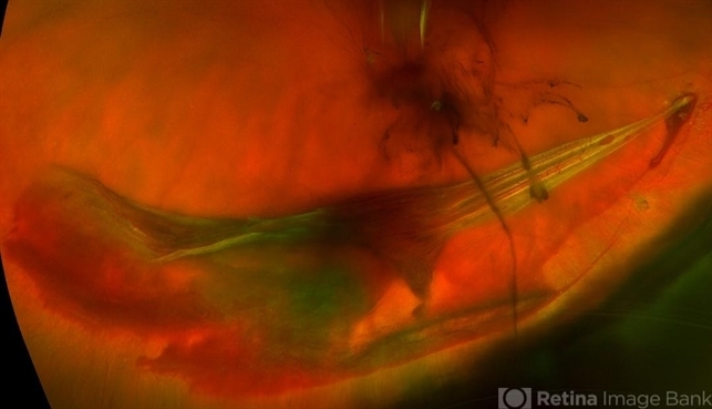 Vitreoretinal Traction With Adjacent Tear And Vitreous Hemorrhage