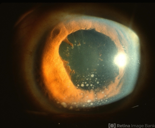 Toxoplasmosis Uveitis with Mutton Fat KP and Broken Posterior Synechia ...