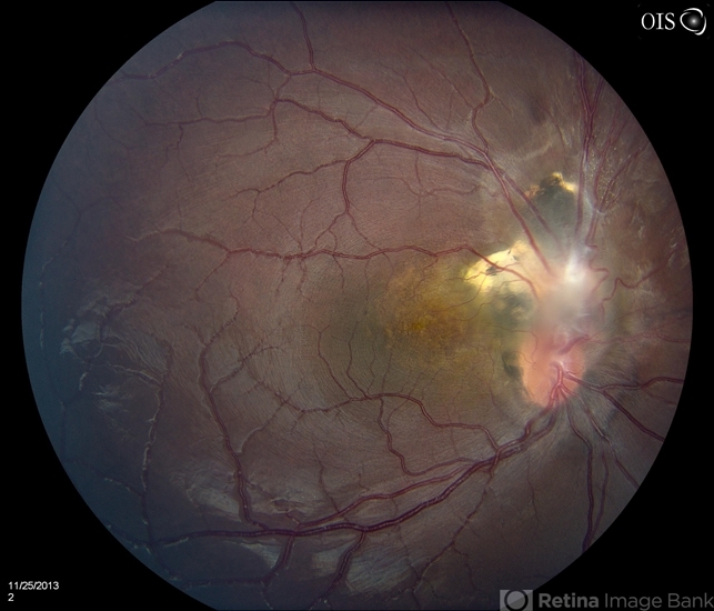 Brain Tumor Pressing On Optic Nerve In Adults