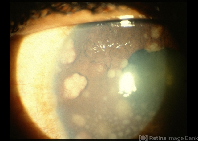 Sarcoid Bussaca Iris Nodules - Retina Image Bank