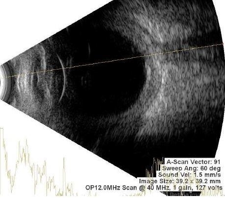 POSTERIOR SCLERITIS - Retina Image Bank