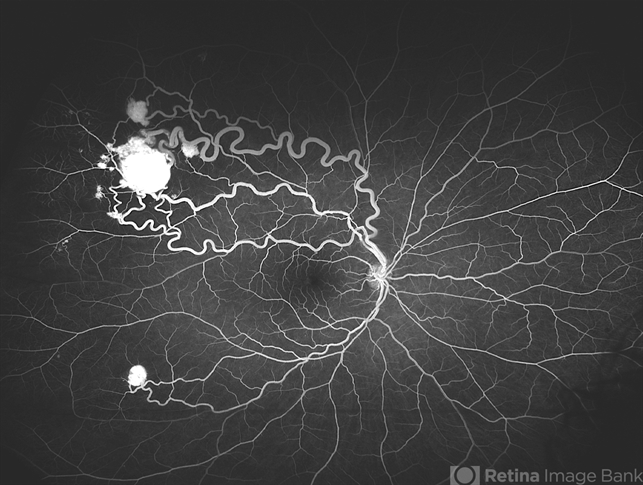 Von Hippel Lindau With Retinal Capillary Hemangioma - Retina Image Bank