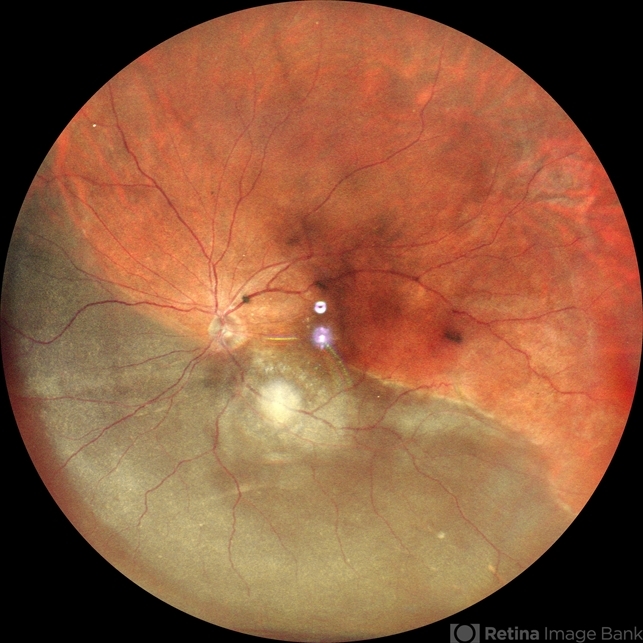 Retinal Detachment - Retina Image Bank