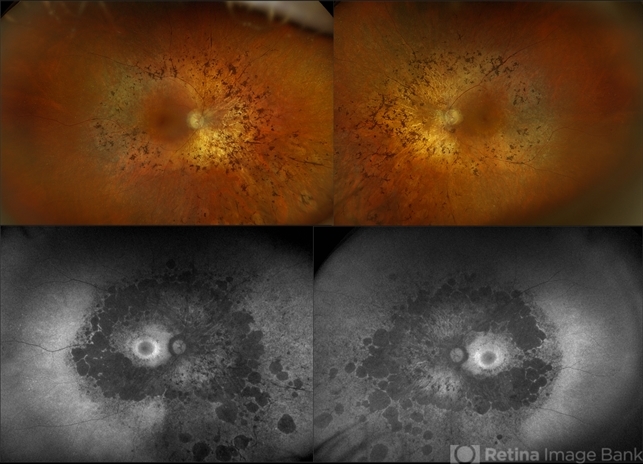 Retinitis Pigmentosa - Retina Image Bank