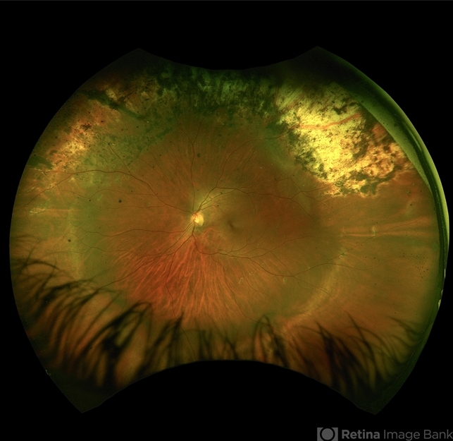 Retinal Band Fully reattached retina following scleral buckling with a 360 ...